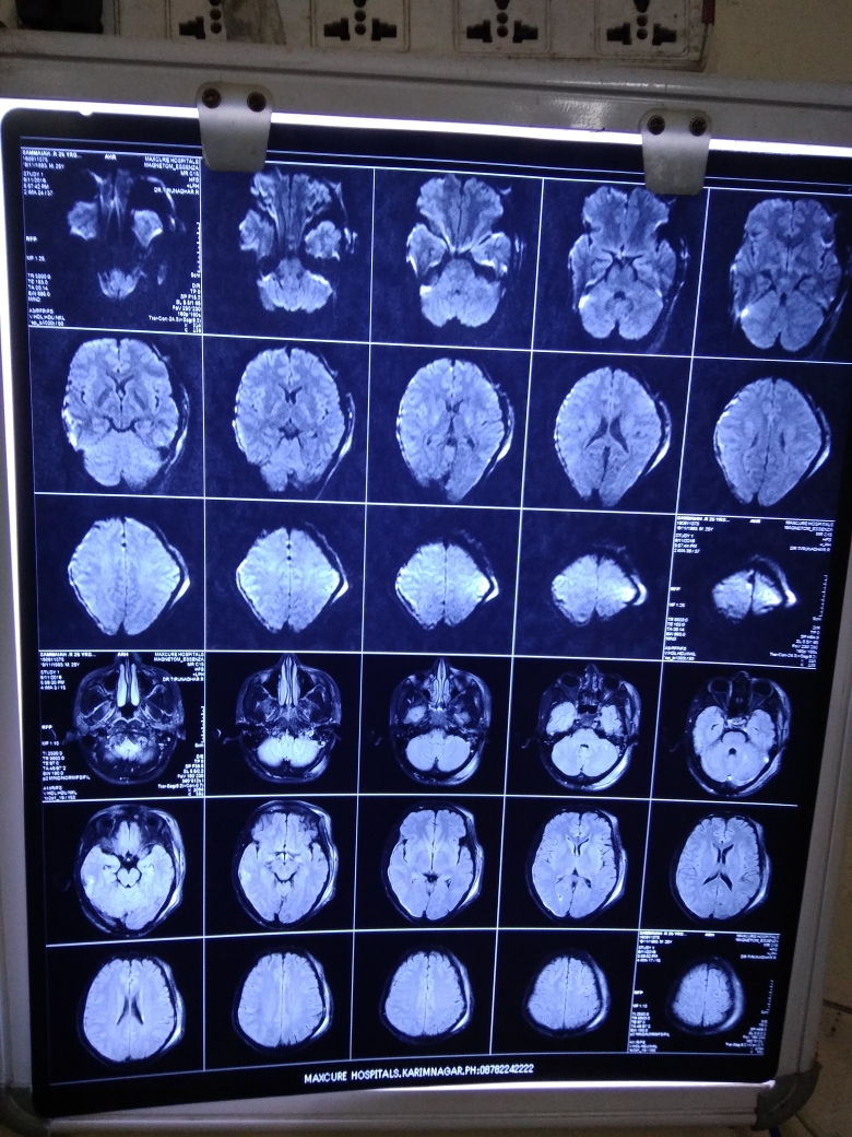 Since 4 Days Trauma To Head CSF Leak