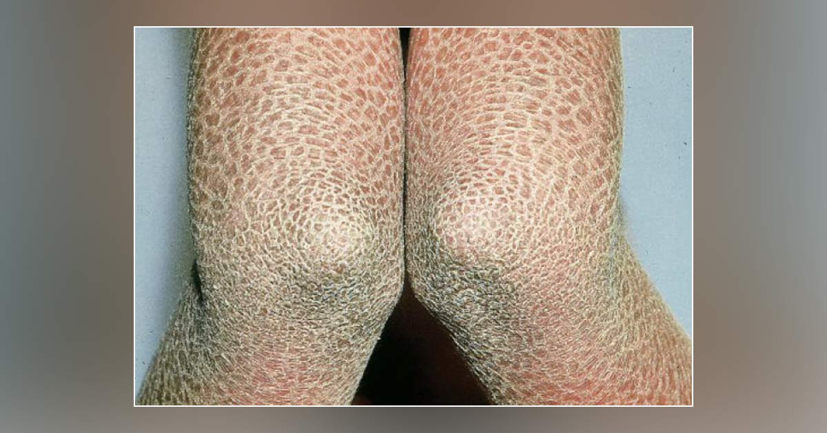 Identify The Skin Lesion