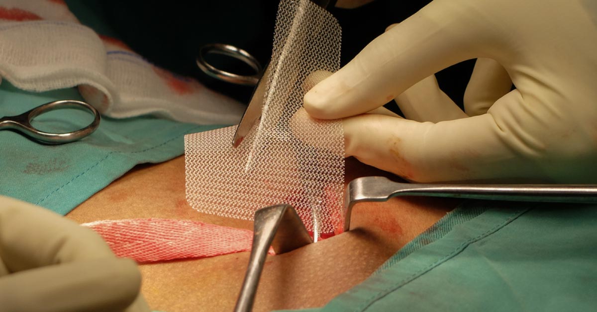Male Infertility May Occur After Open Or Lap Meshplasty To Repair Inguinal Hernia