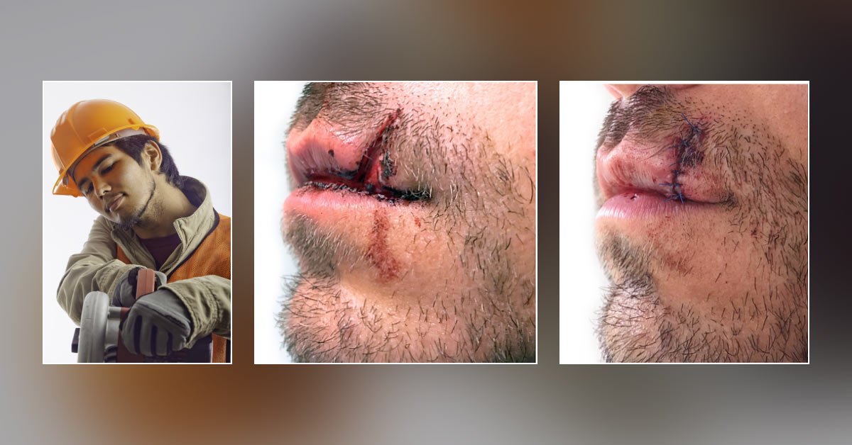 28-year-old Man Wounded by Power Saw