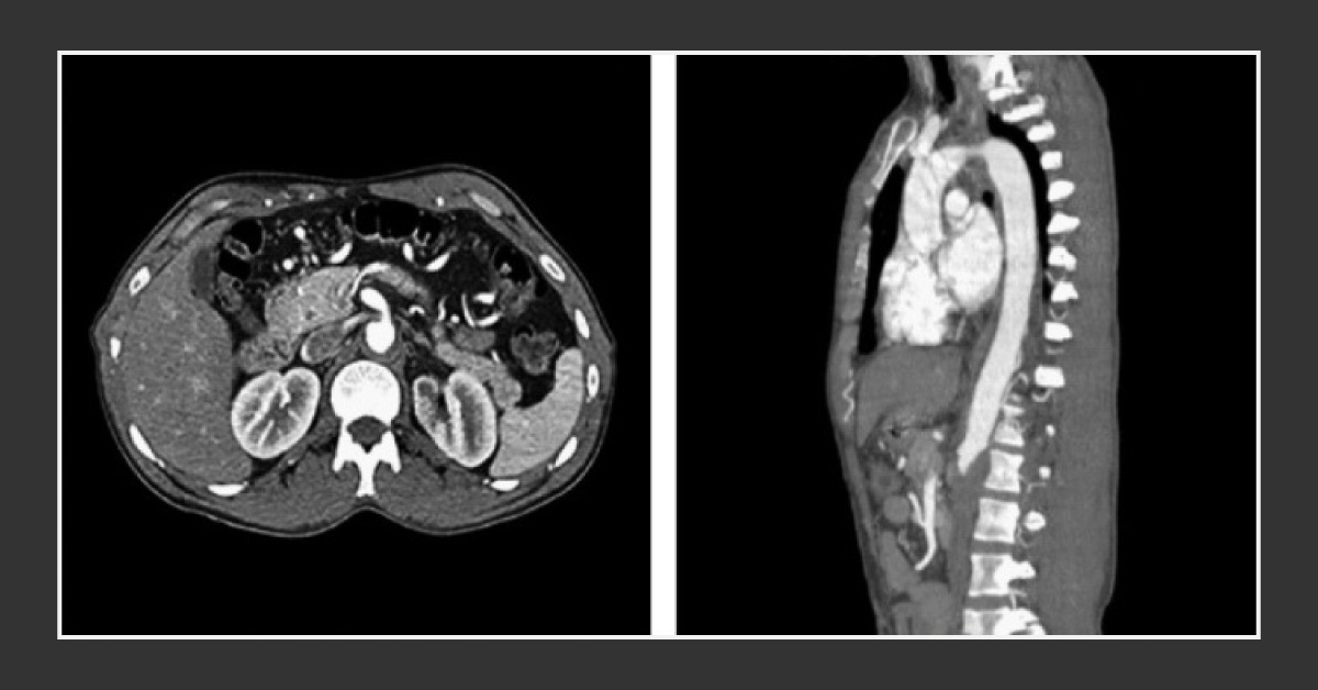 Case of a Young Man with Abnormally High BP