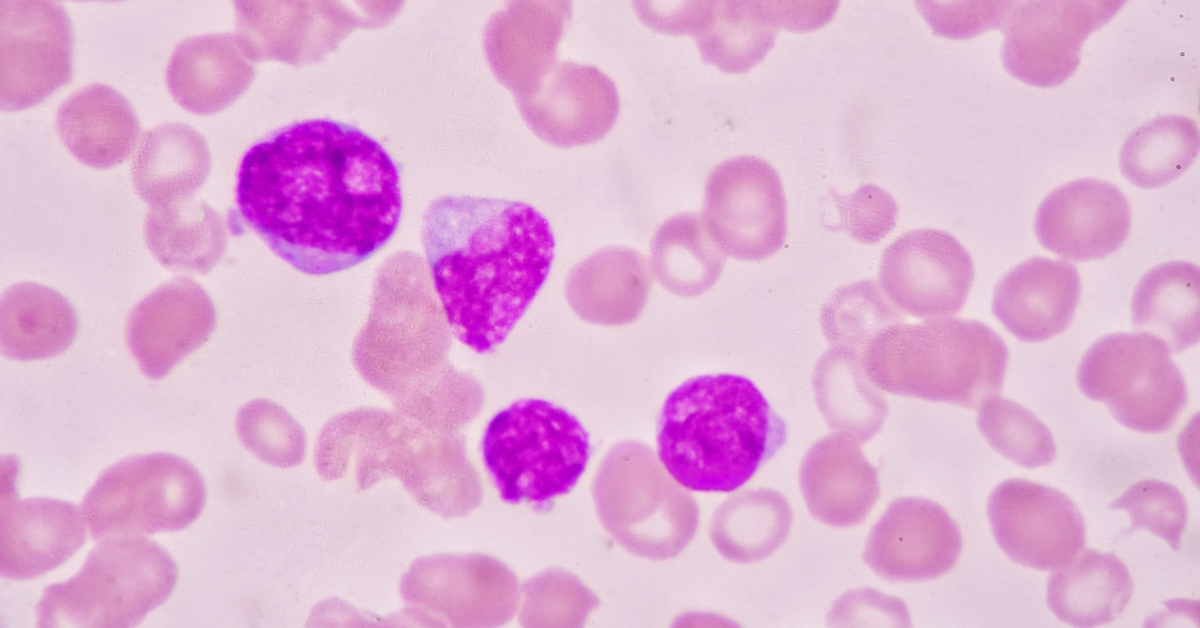 Chronic Lymphocytic Leukaemia- Frequently Asked Questions