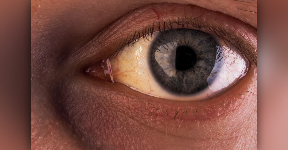 Brief Review On The Scenerio Of Ataxia Telangiectasia