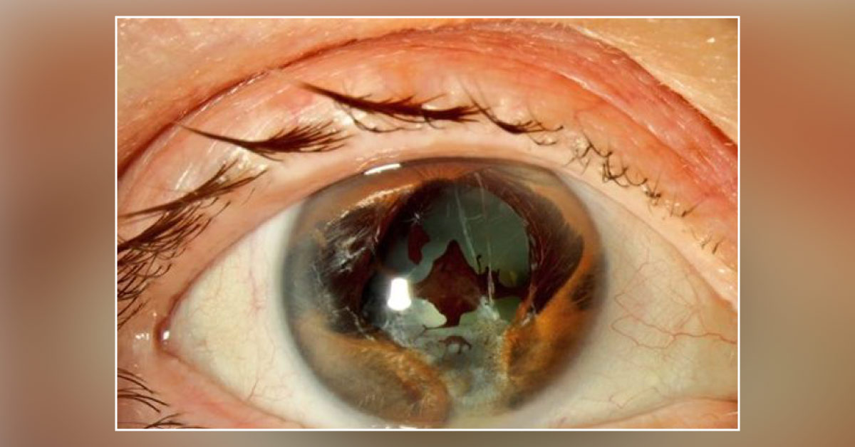 Identify The Ophthalmic Condition
