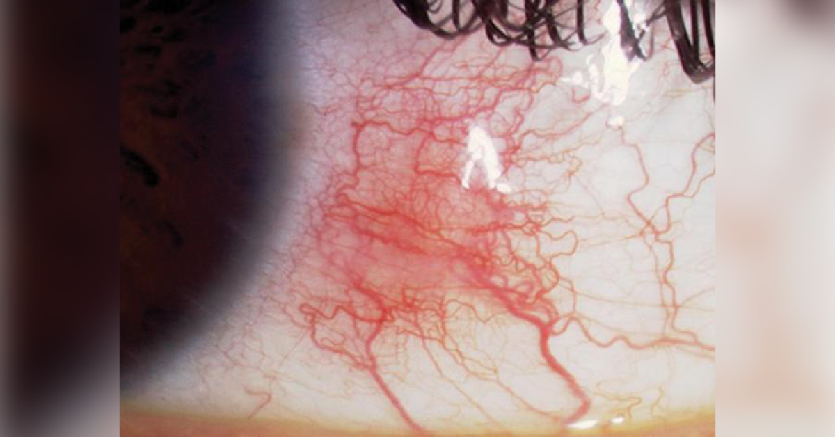 Spot The Ophthalmic Abnormality