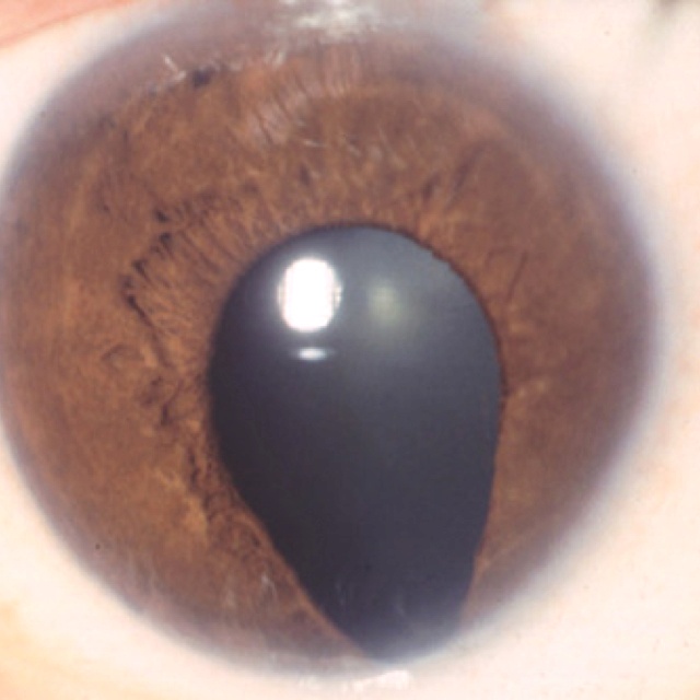 Define The Eyeball Condition