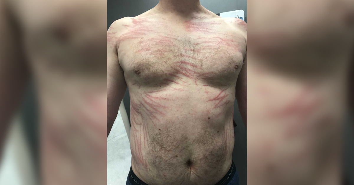 A 50-year-old Man with Pruritic Rashes