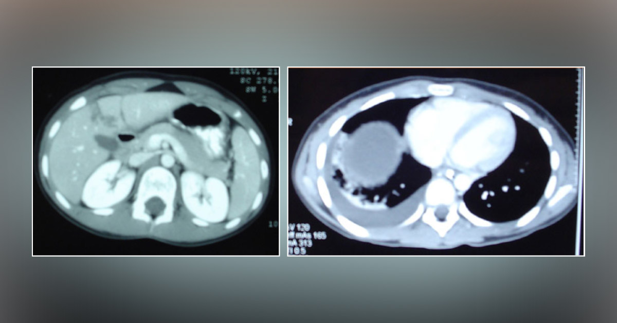 Case of a Young Girl with a History of a Fall