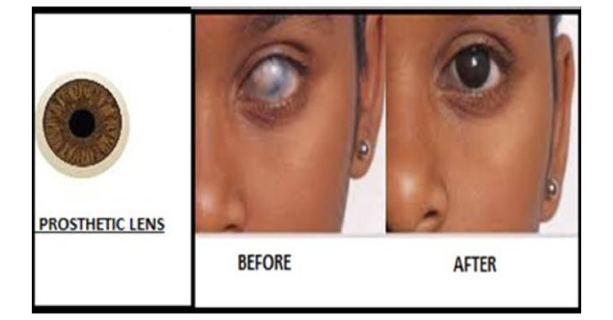 Advantages Of Prosthetic Lenses