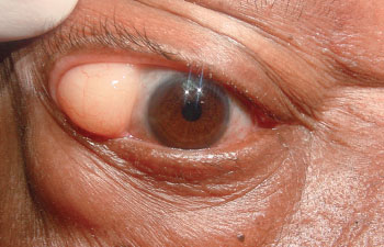 How To Treat This Ophthalmic Condition?
