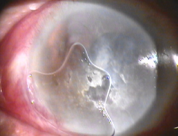 Spot The Ophthalmic Abnormality