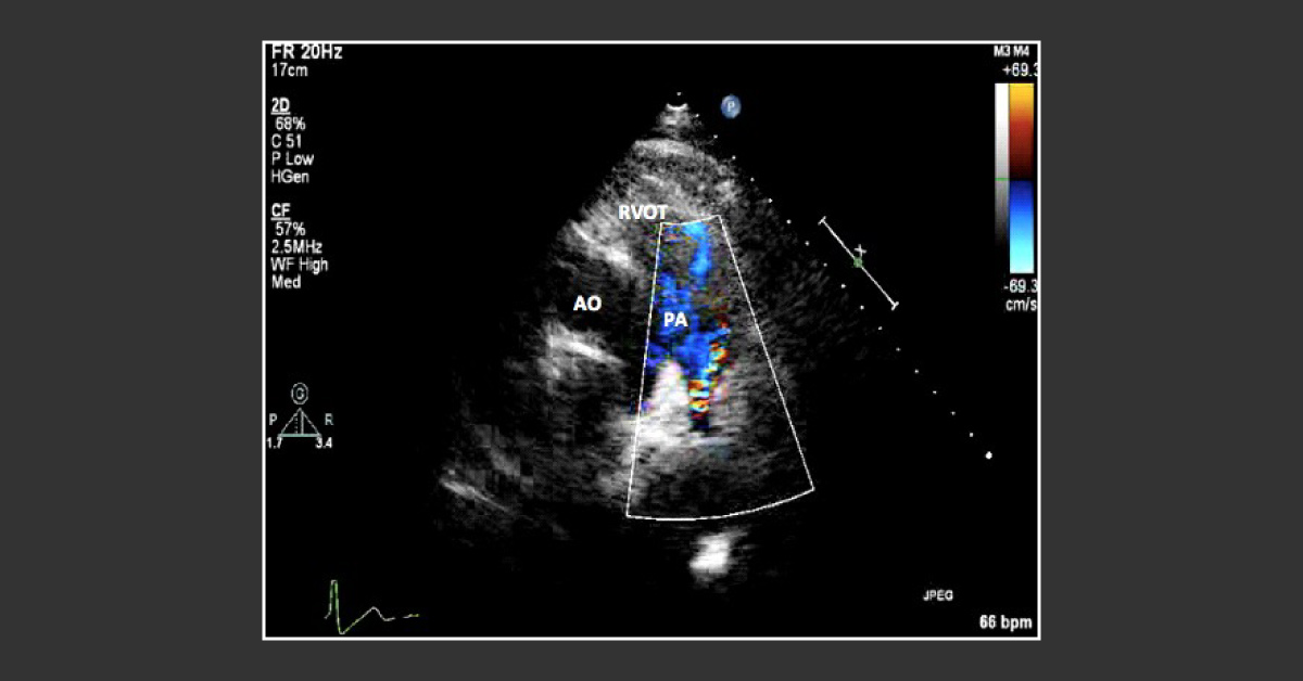 Murmur During Pre-pregnancy Check Up