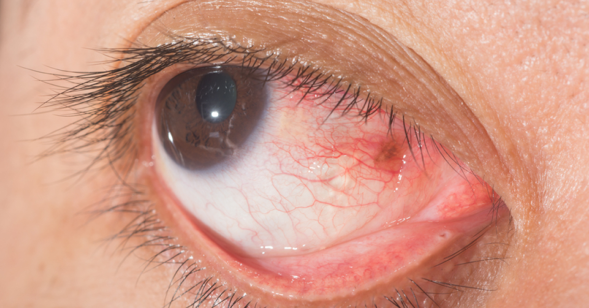 Brief Review On Ocular Manifestation