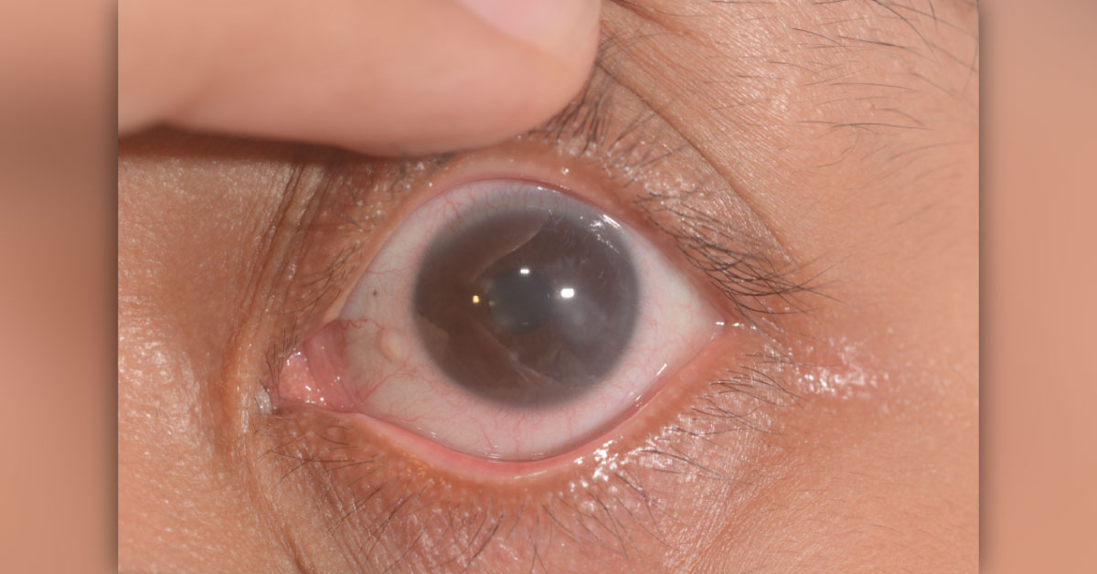 Brief Review On Causes Of Sclerosing Keratitis