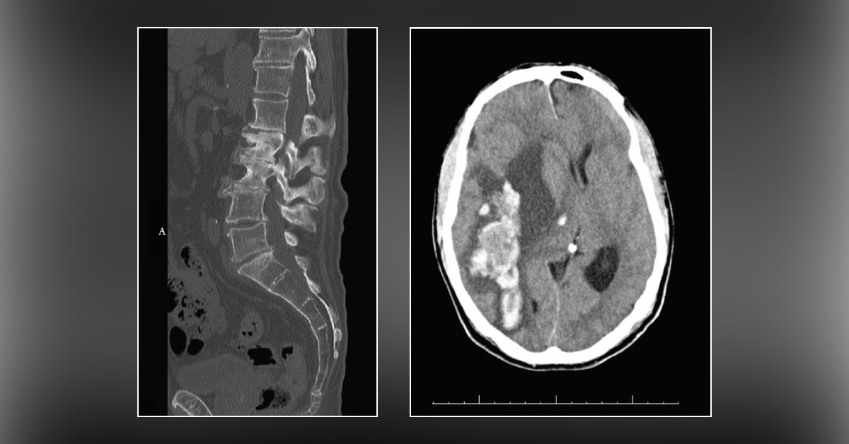 Case of a Geriatric Man with Severe and Sudden Onset Lumbar Back Pain