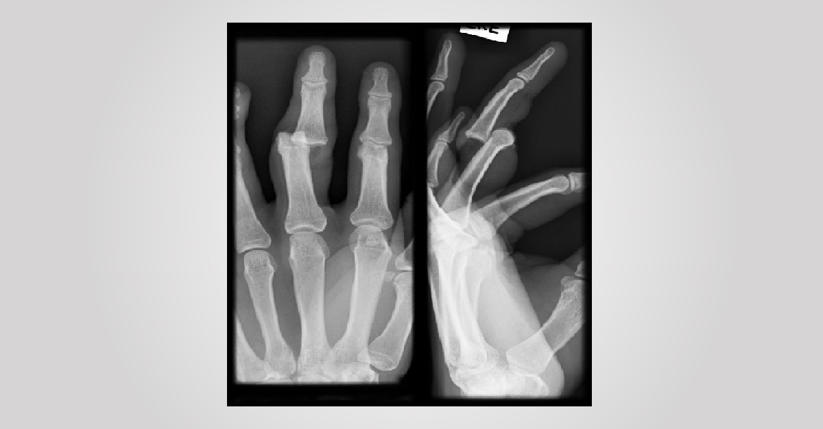 Football Player With Fracture