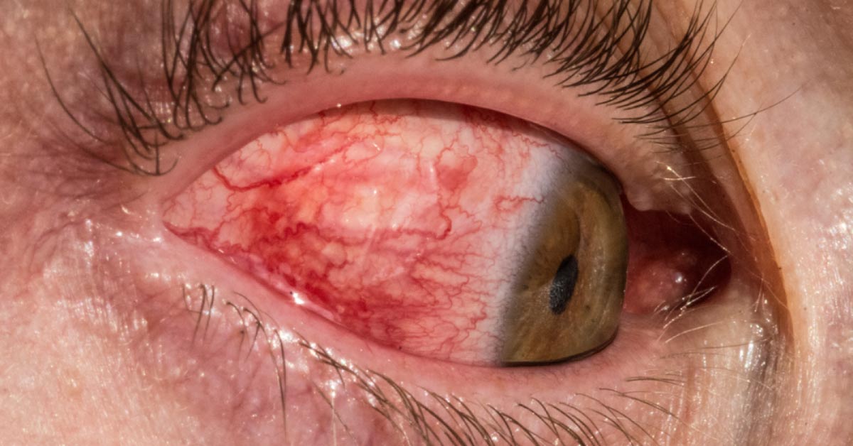 Review On Hemophthalmos