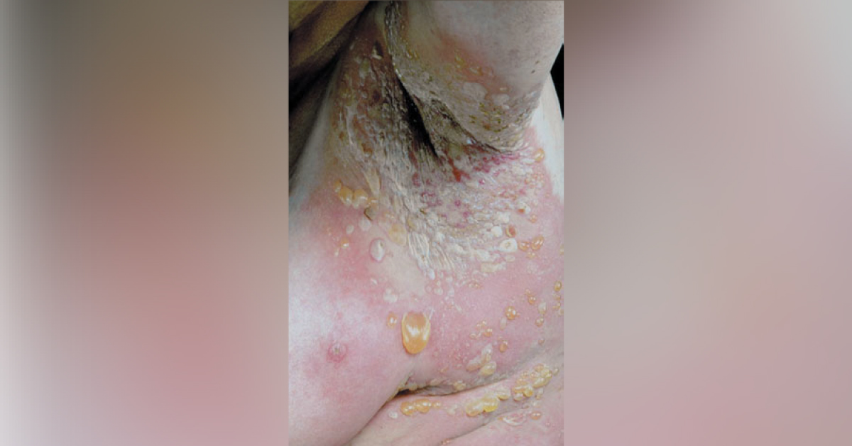 Generalized Itchy Blistering Eruption In An Elderly Woman