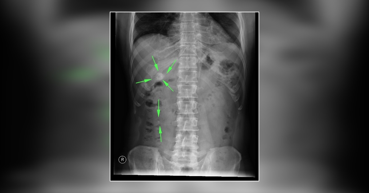 Diagnose This Abdominal Condition