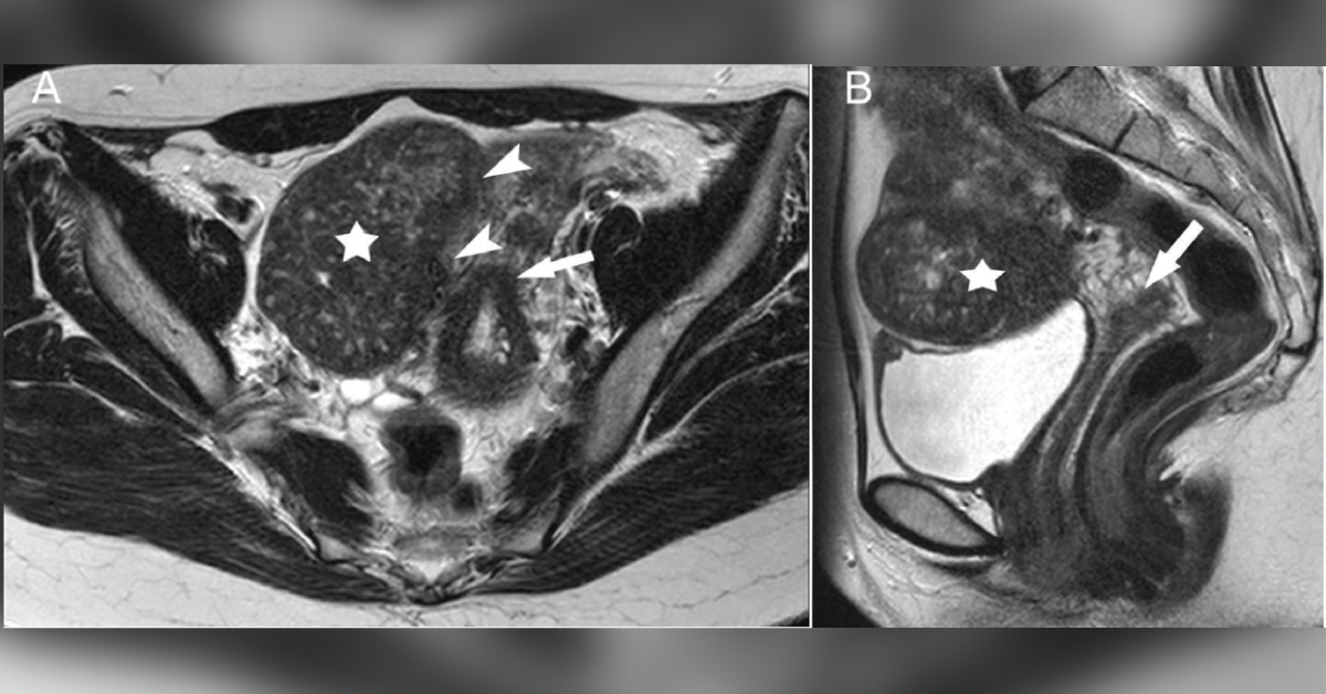 Case of Dyspareunia and Secondary Dysmenorrhea