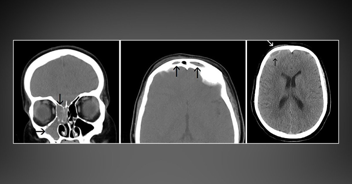 14-year-old With Forehead Swelling