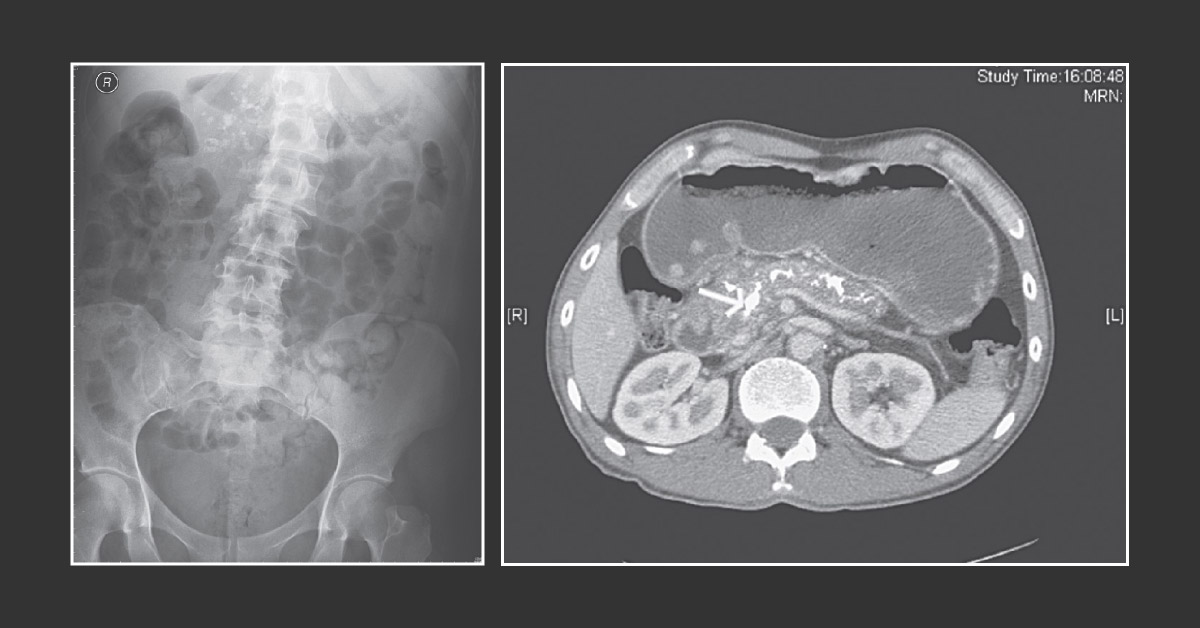 Case of a Patient with Chronic Epigastric Pain