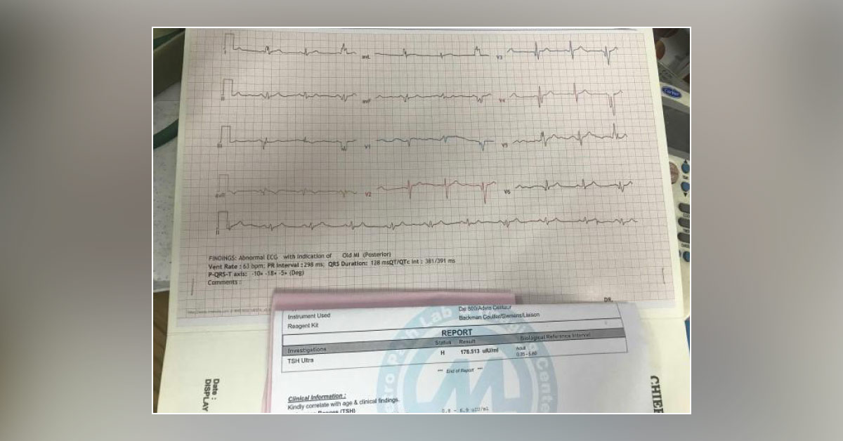 Is There Any Specific Findings In This ECG?