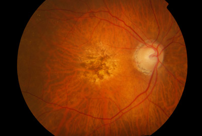 What Is Juvenile Macular Degeneration And Its Management?