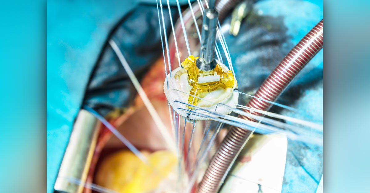 Artificial Heart Valves: A General Concept
