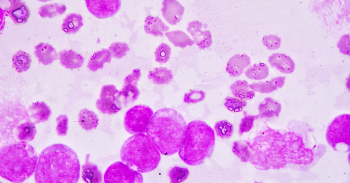 Acute Myeloid Leukaemia: Frequently Asked Questions