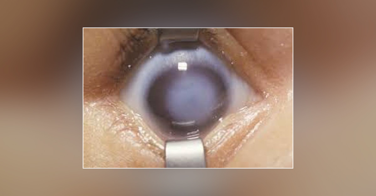 Review On Scenario Of Corneal Lesions