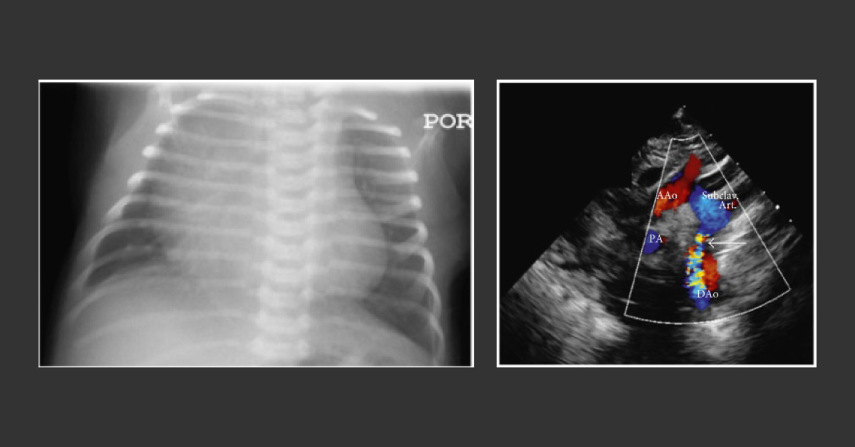 Diagnose This New-born With Worsening Tachypnea