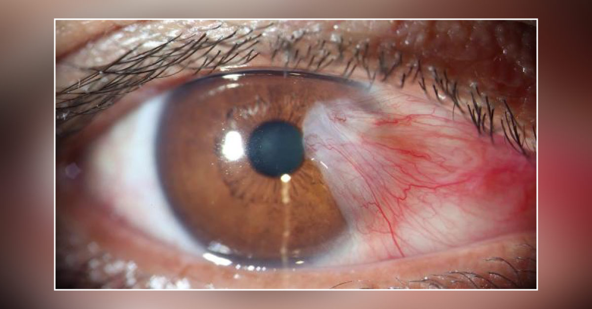 Brief Review On Surgical Procedure For Pterygium
