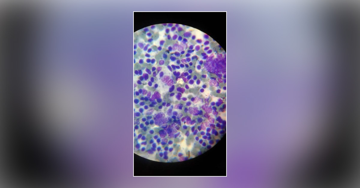 Diagnose This Fine Needle Aspiration Cytology