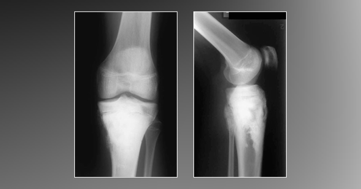 An Expanding Mass In The Leg Of An Adolescent
