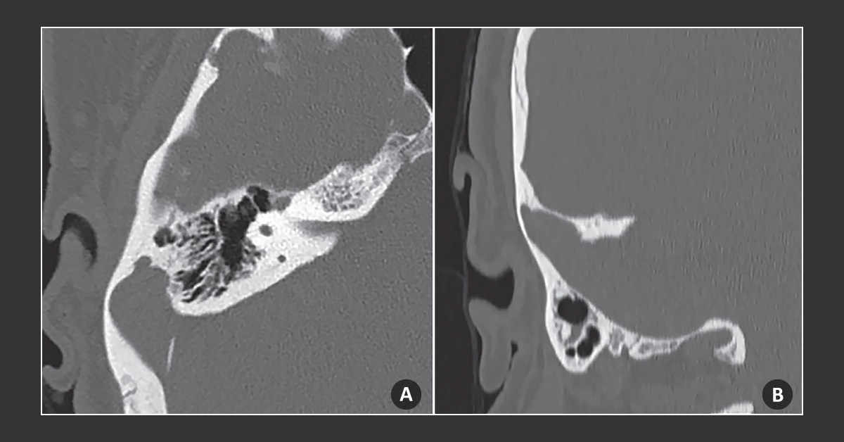 A Case of Pulsatile Tinnitus