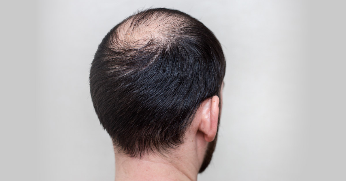 A New Study Shows Reverse Hair Loss And Skin Damage Linked To Fatty Diet