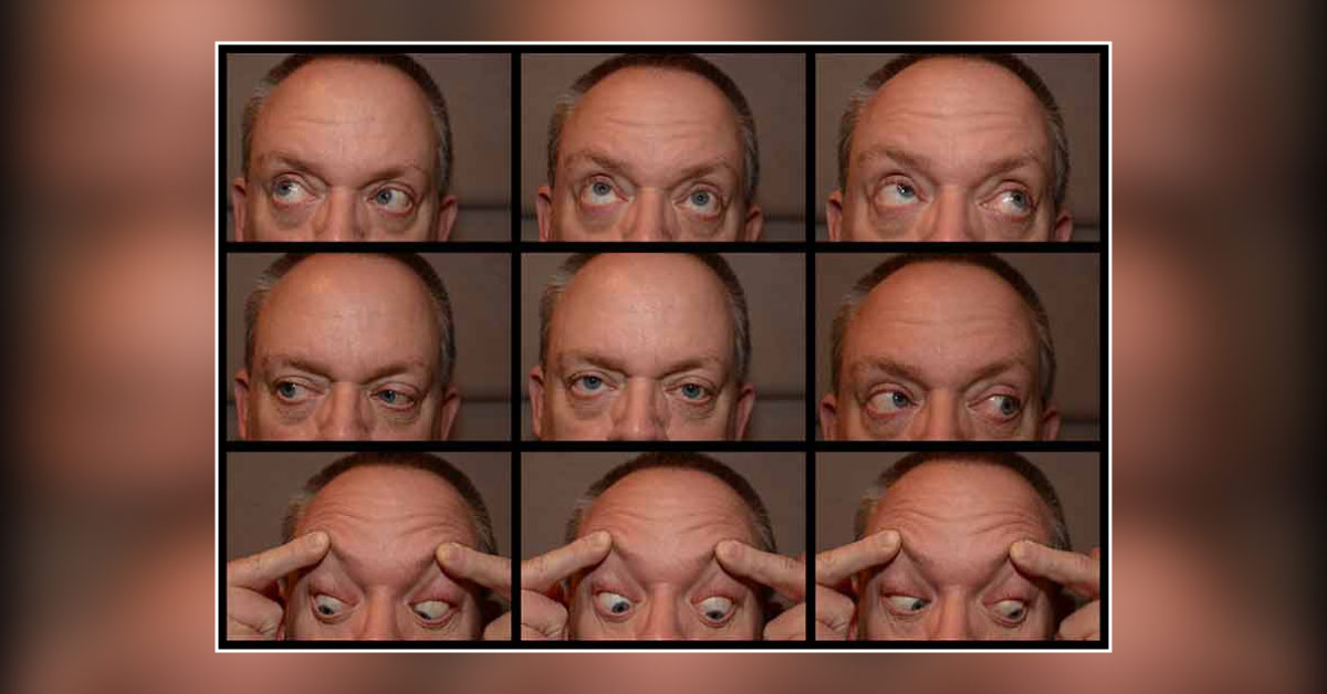 A Man With Vertical Diplopia
