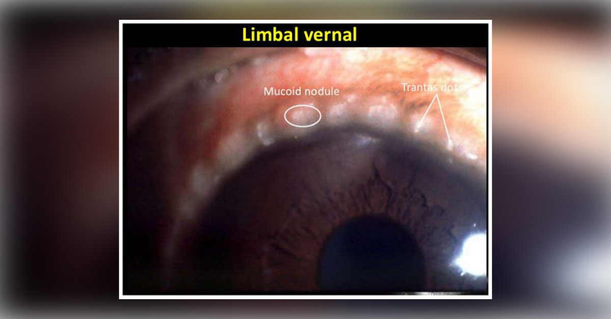 Brief Scenario On Bilateral Vernal Keratoconjunctivitis