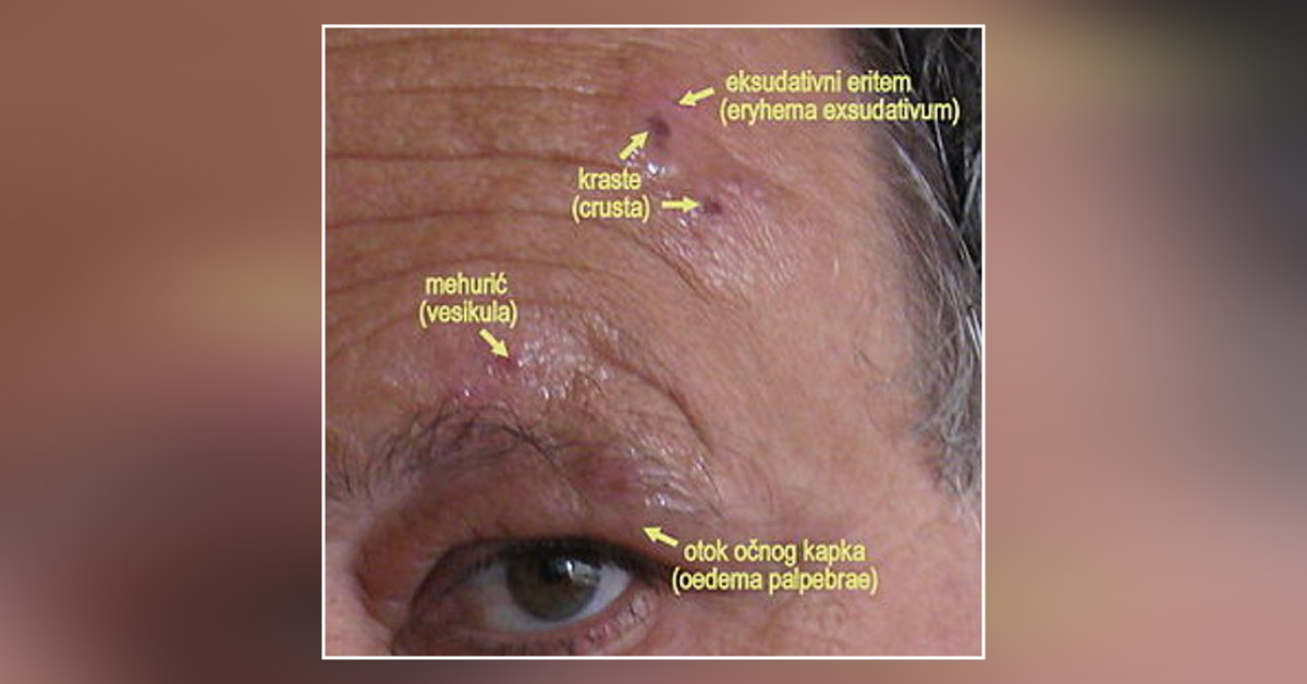 Diagnose this Infectious Ophthalmicus Condition
