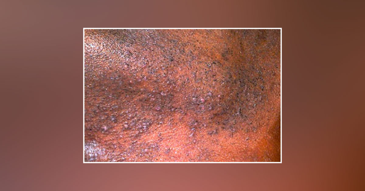 Identify The Lesion On Face
