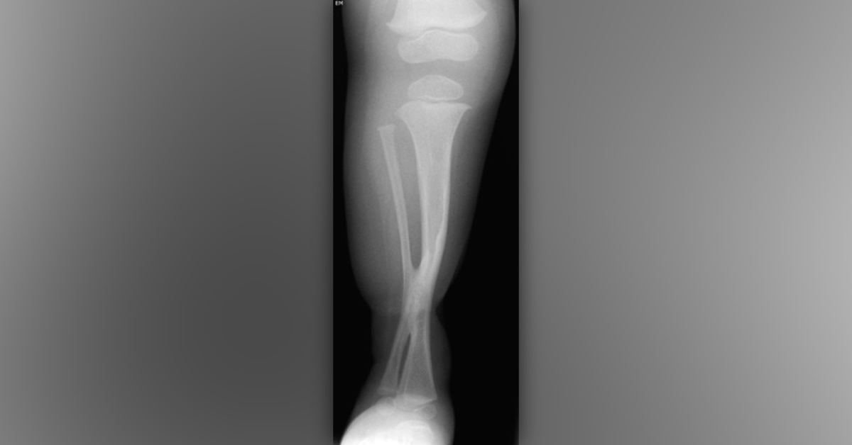 Leg Deformity In A Baby
