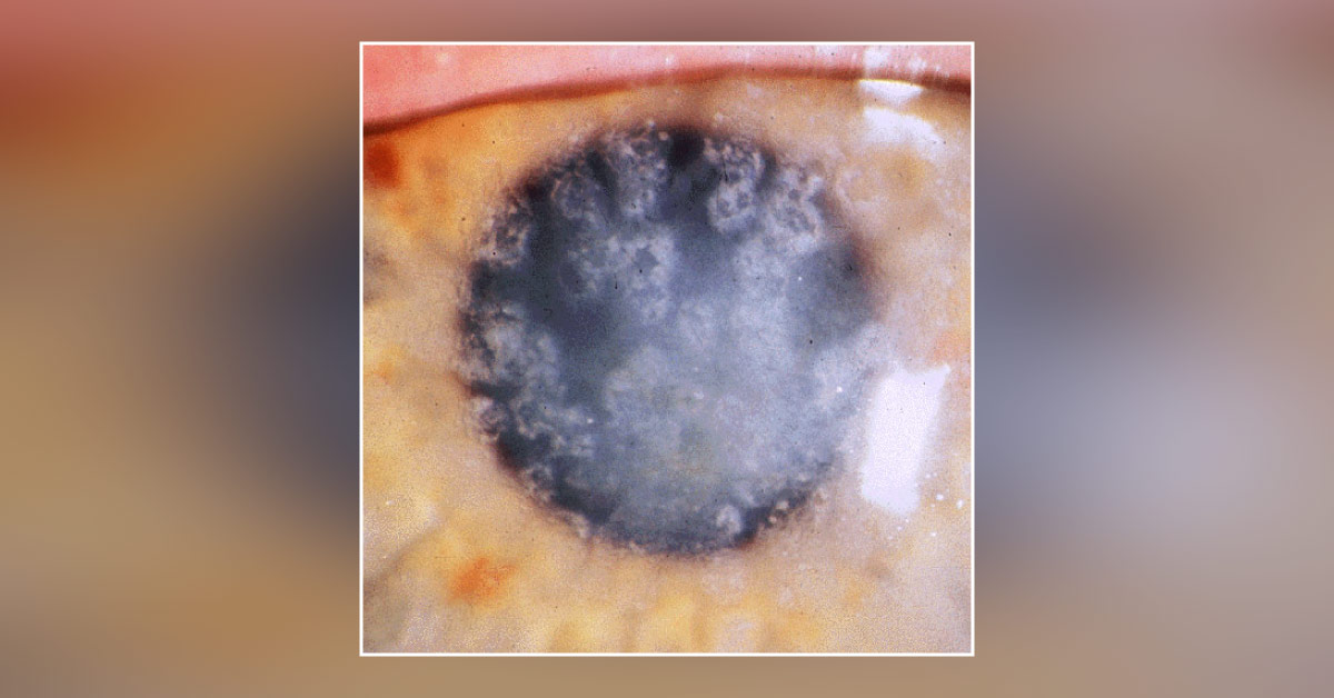 Congenital Anomalies Associated With Bilateral Congenital Corneal Dystrophy
