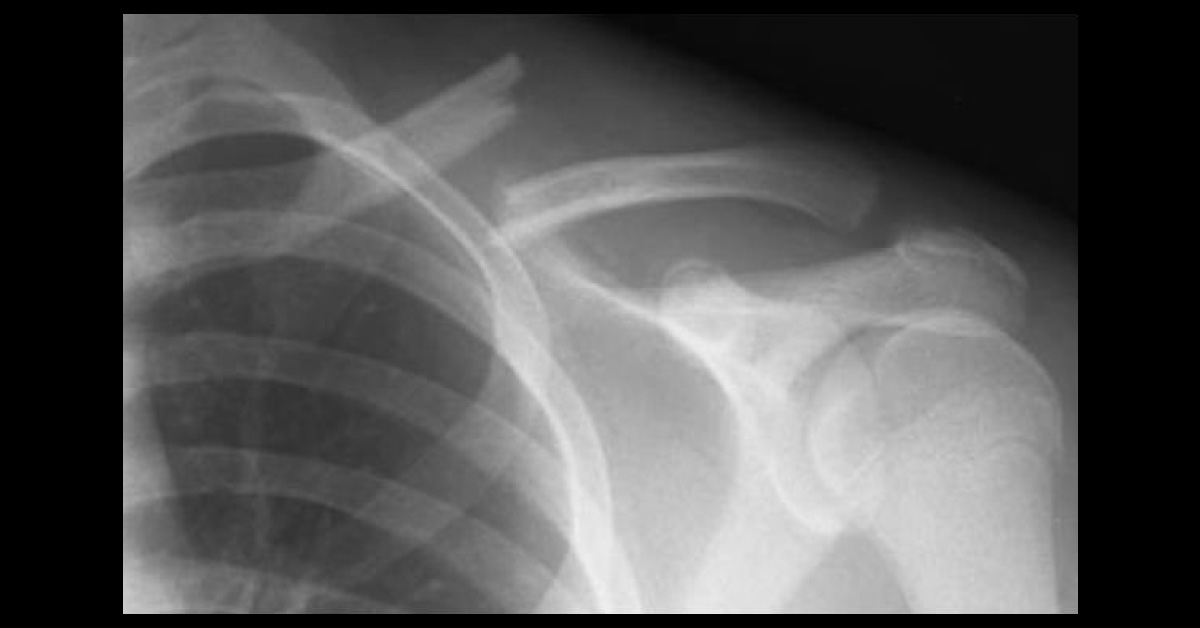 Diagnose This Painful Collarbone