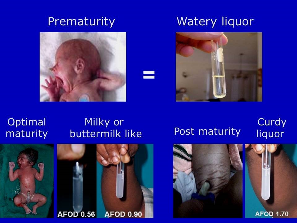 Concept Of Individual Term For Each Fetus Based On Amniotic Fluid Optical Density (AFOD) Part- I