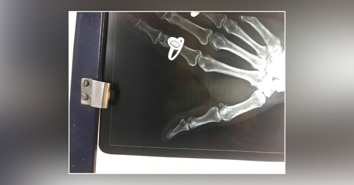 Is This A Fracture Of Metacarpophalangeal Joint