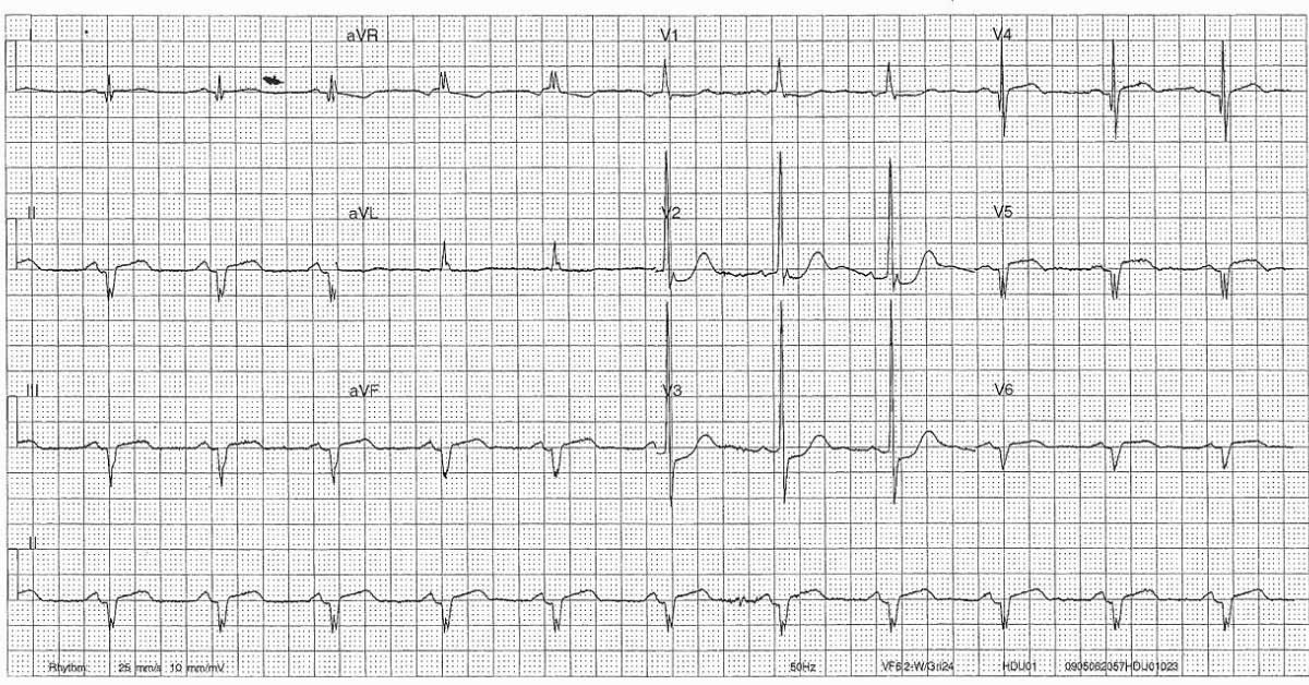Can You Interpret This ECG!