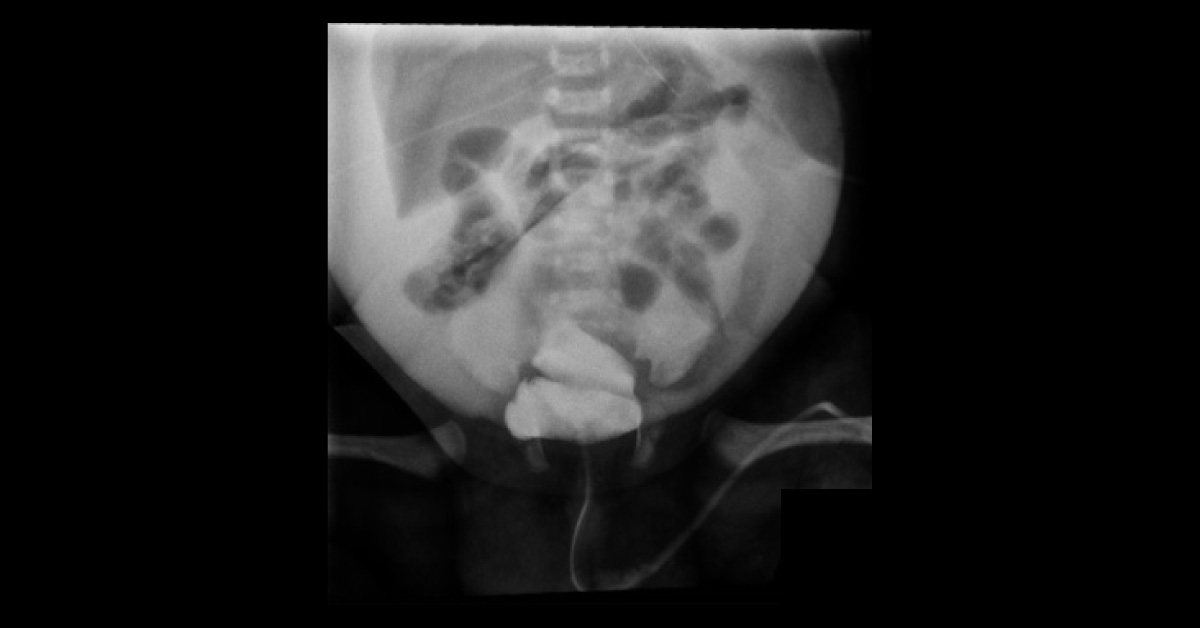 A Newborn With Increasing Abdominal Distension