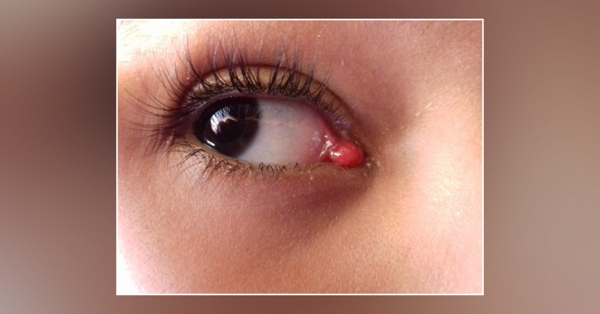Asymptomatic Swelling In The Eye