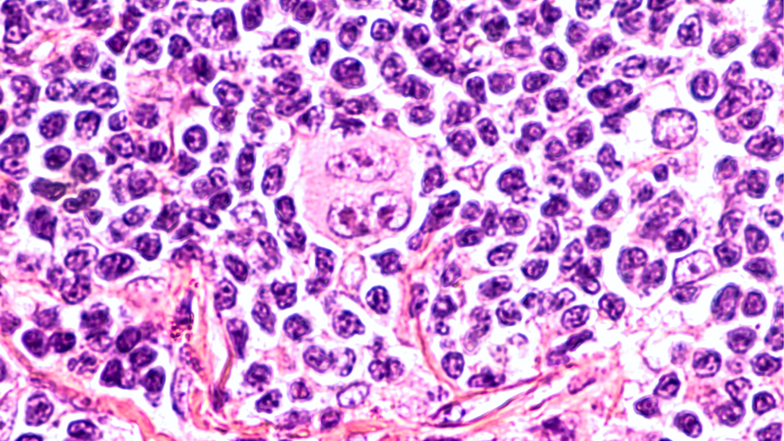 Lymphoma: Frequently Asked Questions